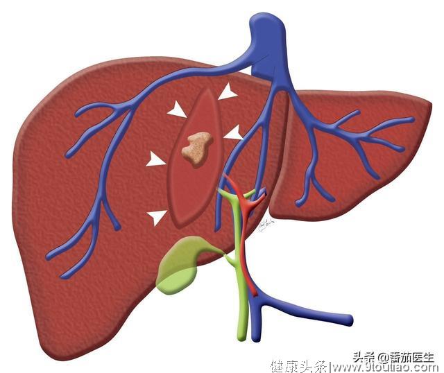 长期饮酒导致肝脏脂肪性变 随着代谢分解障碍 发生脂肪肝！