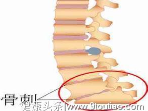 颈椎长了骨刺就是得了颈椎病？怎么办？