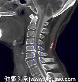 骨科医生终于用最简短的文字，说出了“骨质增生的奥秘”