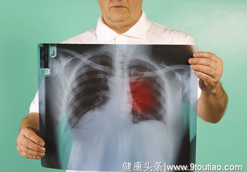 肺癌多数是“拖”出来的！一旦身体3处疼痛，最好去查一下肺CT