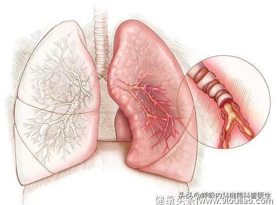 哮喘、慢阻肺、肺炎，最容易打垮老年人的这三种肺疾病应如何应对