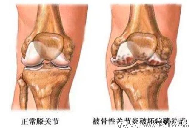 “O”型腿、膝盖痛？小心膝关节骨关节炎找上你！