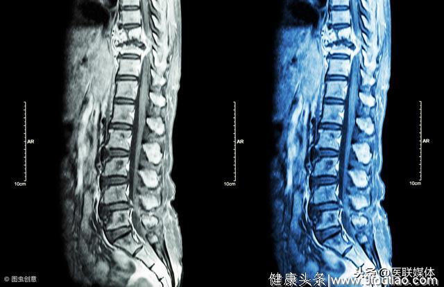 强直性脊柱炎是“不死癌症”？总是觉得这里疼，或是它来了