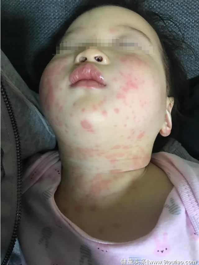 网友分享宝宝“川崎病”治疗全过程， 恐怖，不知道都以为是感冒