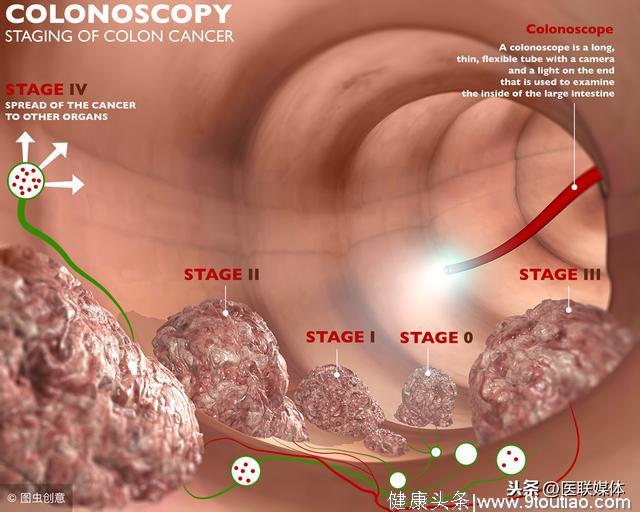 肠癌早期没感觉？医生重申：得用2种检查手段“揪出来”