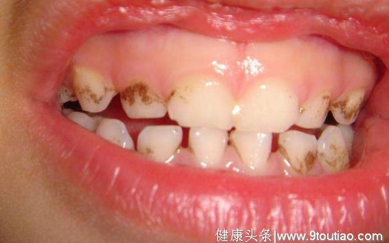 儿童牙齿保护攻略——宝宝牙齿上的牙菌斑千万不要忽视！