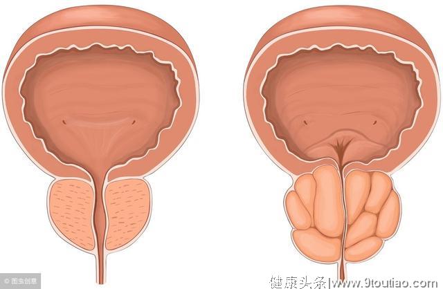 尿频尿痛尿不尽，可能是前列腺增生，可以试试这个运动，效果好