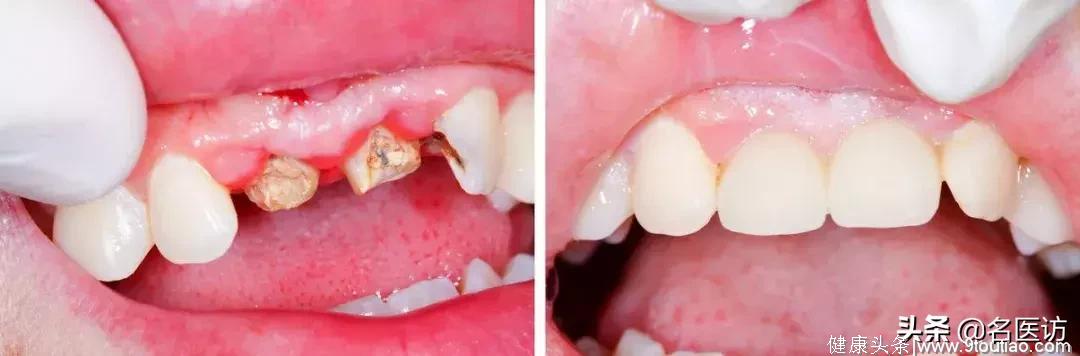 儿童口腔健康-预防龋齿