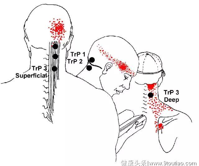 为什么多数头痛都缘于颈椎？