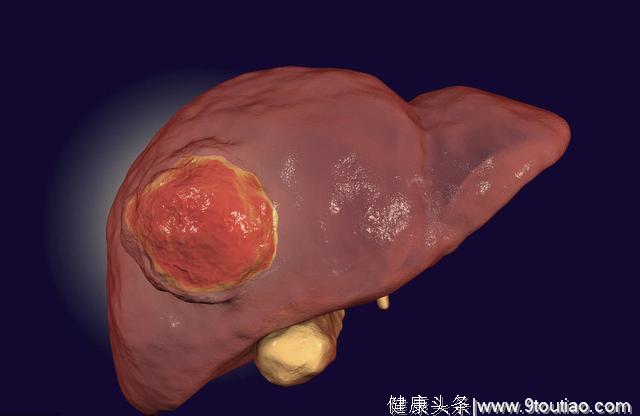 为何我国“肝癌”人数暴增？医生提醒：只怪国人总忽略4个症状！