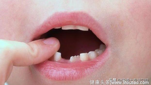 换牙期的儿童想让牙齿长得整齐？需要注意哪些事项？