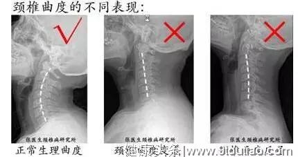 X片检查“颈椎生理曲度变直”，要怎么治疗？