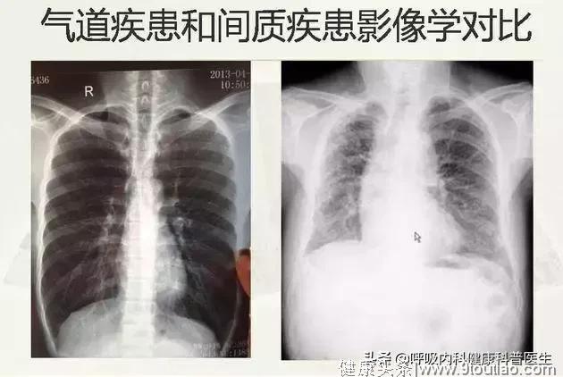 哮喘、肺气肿、慢阻肺为什么会使肺功能下降？用“人话”说说肺