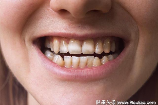 牙齿上出现这些斑点，要小心这种免疫性疾病