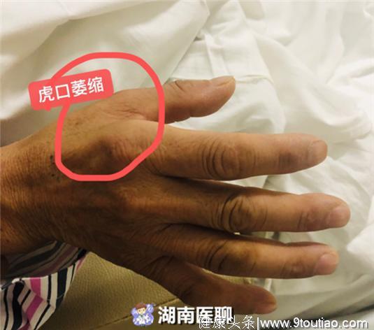 手指老又麻又痛得了颈椎病？别忽视另一“元凶”——肘管综合征！