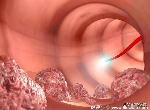 肠癌多数是“拖”出来的！“大便”出现3个症状，最好去查下肠镜