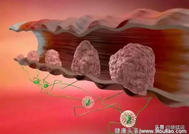 肠癌多数是“拖”出来的！“大便”出现3个症状，最好去查下肠镜