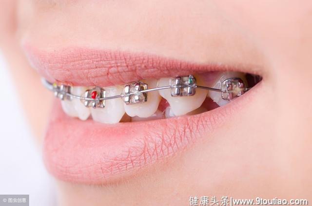 杭州成年人做牙齿矫正需要多少钱?