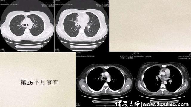 小细胞肺癌像水泥浆一样难缠，生存期3个月到5年，差异原因在哪？