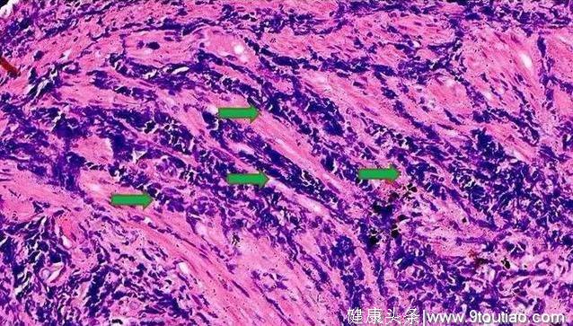 小细胞肺癌像水泥浆一样难缠，生存期3个月到5年，差异原因在哪？