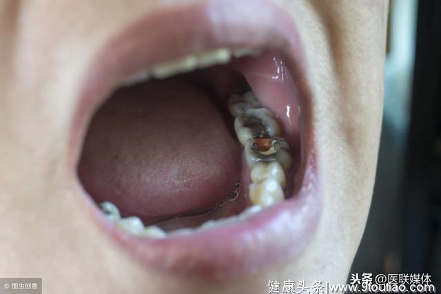 牙齿有小黑点，提醒你要失去这颗牙了？明白龋齿的3个阶段