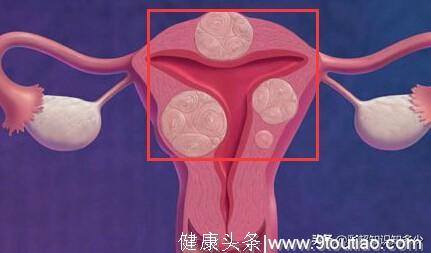 女性痛经，别忽视了这个病——子宫内膜异位症