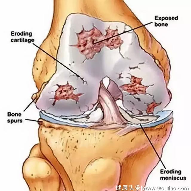 膝盖痛自疗法：滑膜炎、骨关节炎、半月板损伤都有效