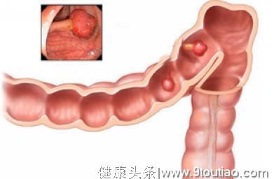 90后夫妻双上确诊肠癌，医生惋惜：吃饭时这么吃不患"癌"才怪！