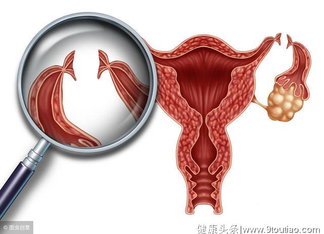 子宫肌瘤的症状 月经有这变化竟是子宫肌瘤