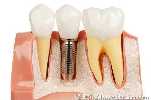 合肥哪家种植牙齿好？