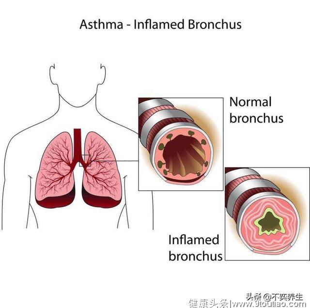 食养妙方之哮喘
