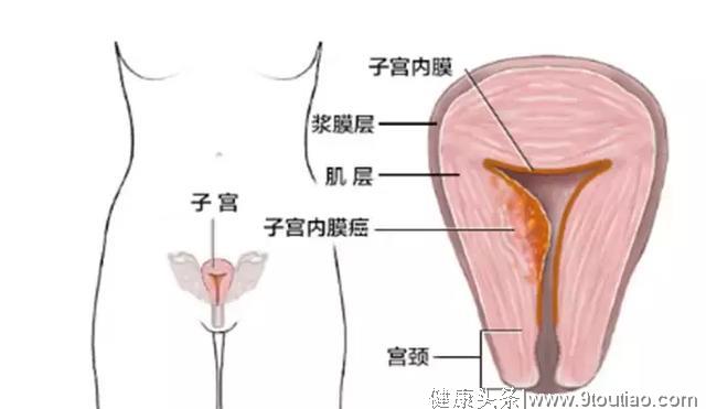 子宫内膜厚度是多少，如何科学保养子宫内膜
