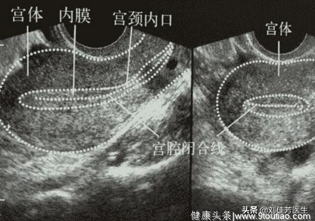 女性不孕的一大凶手，子宫内膜过厚，早调理就早成功怀孕