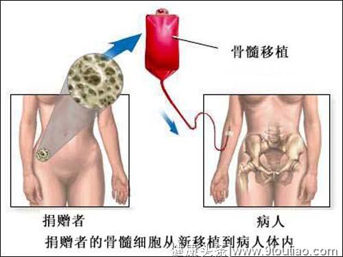 同是白血病，成人和儿童患者为何差别如此大？