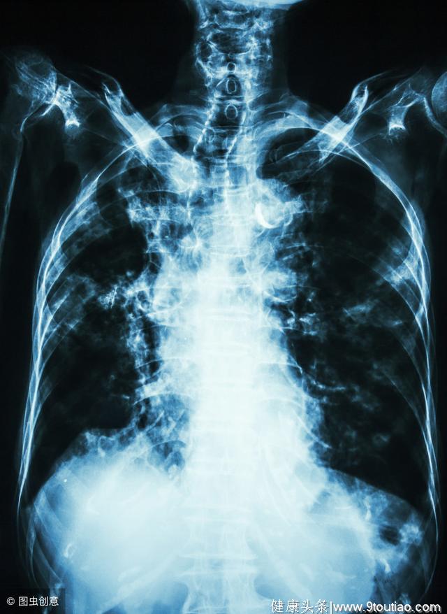 肺癌的致病因素有哪几个