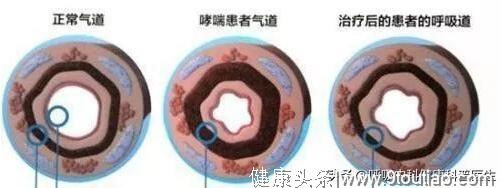 春季哮喘高发！什么原因会诱发哮喘？哮喘预防五个方面要注意