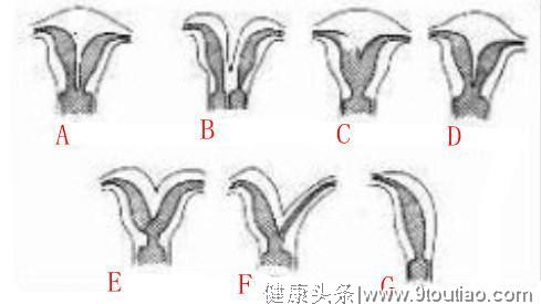 反复着床失败，看看八种异样子宫，妊娠难度是否难倒了你？