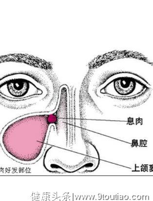 什么是萎缩性鼻炎？萎缩性鼻炎能治好吗？记住日常怎样预防。