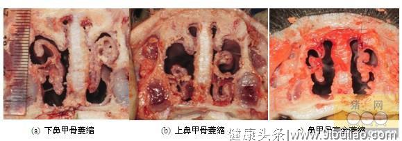 什么是萎缩性鼻炎？萎缩性鼻炎能治好吗？记住日常怎样预防。