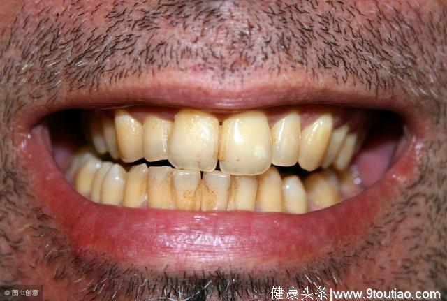 牙齿最容易出现的4个问题，你应该也有！