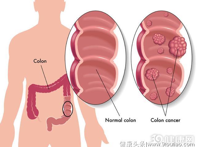 很多肠癌，都是息肉“引出”的！这几类人请定期检查