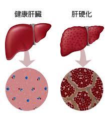 肝癌一发现就晚期？这7个祸根要留意！中医说补肝上火，该咋办？