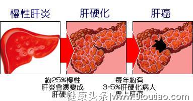 肝癌一发现就晚期？这7个祸根要留意！中医说补肝上火，该咋办？