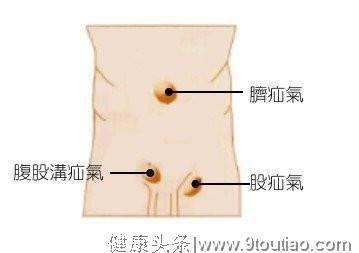 八旬老人疝气复发，肠管膀胱“乱跑”，祸首竟是前列腺增生？