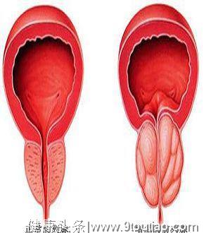 八旬老人疝气复发，肠管膀胱“乱跑”，祸首竟是前列腺增生？