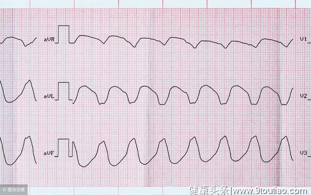 心律失常之早搏那点事儿你了解多少