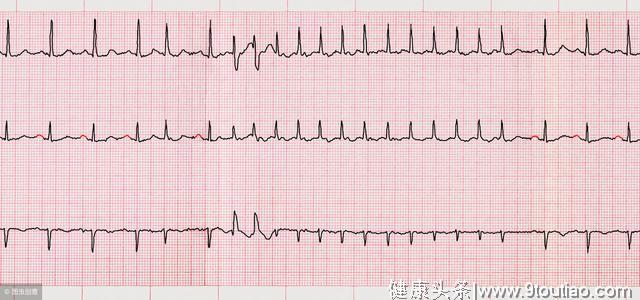 心律失常之早搏那点事儿你了解多少