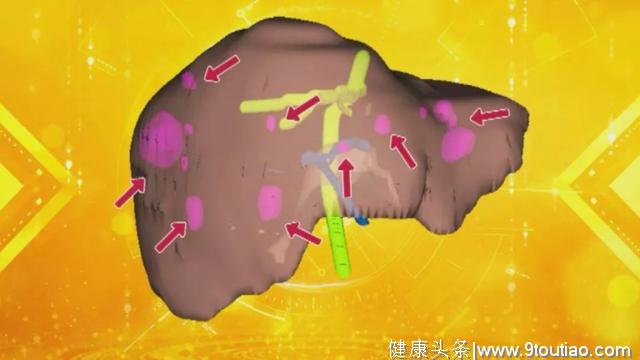 胰腺癌又称“癌王”！但专家提醒：早发现，16个病灶转移都能治