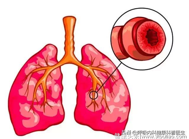 所有的哮喘患者都会喘吗？所有的喘都一定是哮喘吗？
