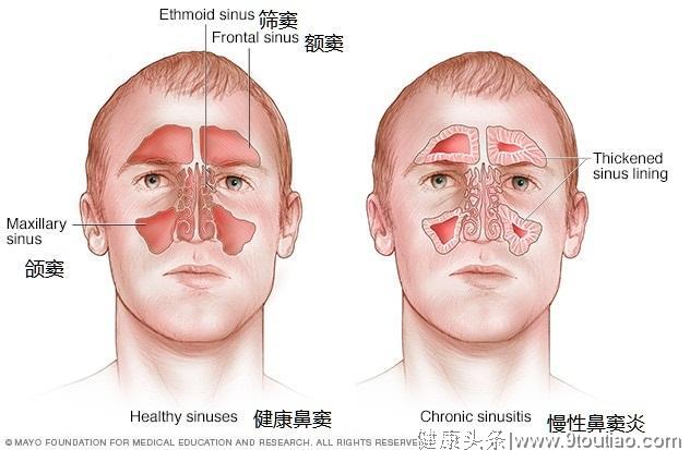 鼻窦炎是怎么回事？鼻窦炎=鼻炎？